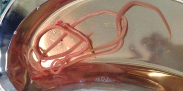 Bağırsakta Solucan Belirtileri ve Tedavisi